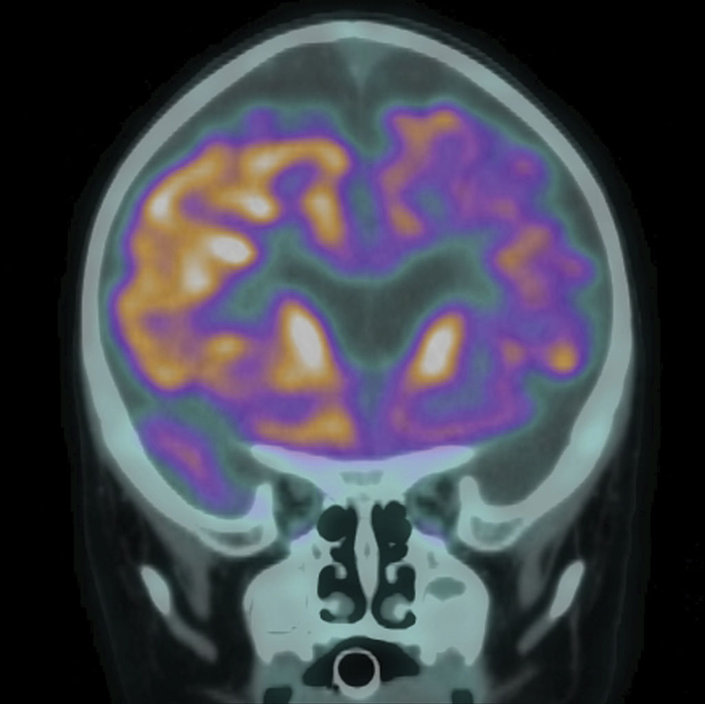 PET Scan