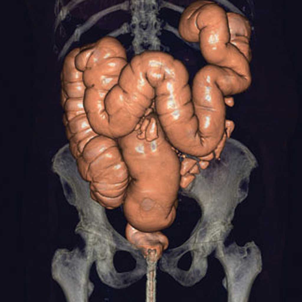 CT Scan Colon