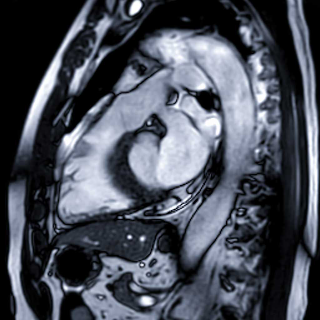 Cardiac MRI