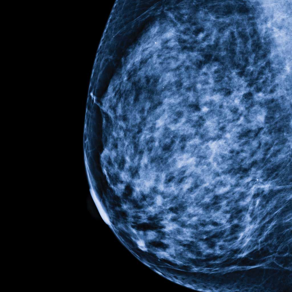 Breast Mammogram